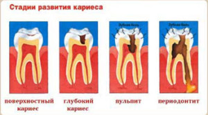 Стадии развития кираса, Лечение зубов в Абакане Дентал, 